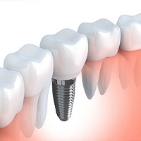 Dental Implants don't get cavities