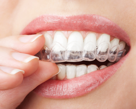 clear aligners being put on upper teeth