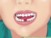 Children might lose permanent teeth