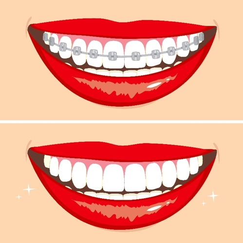 Orthodontic Options – Info on the Two Most Common Braces