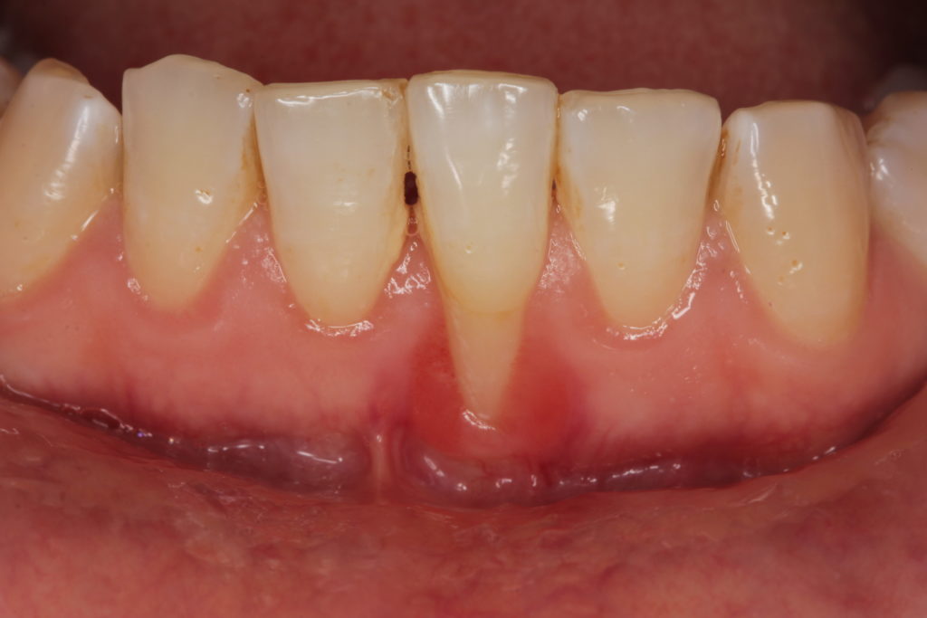  red inflamed gums which are usually a sign of gingivitis