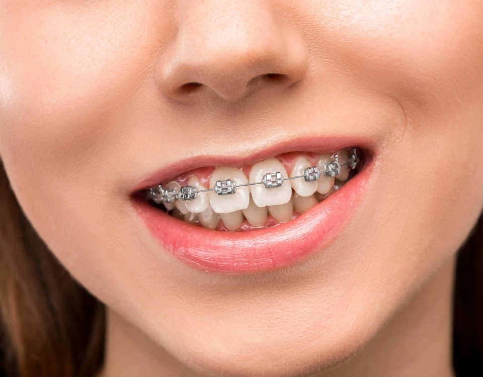 how to care for your braces
