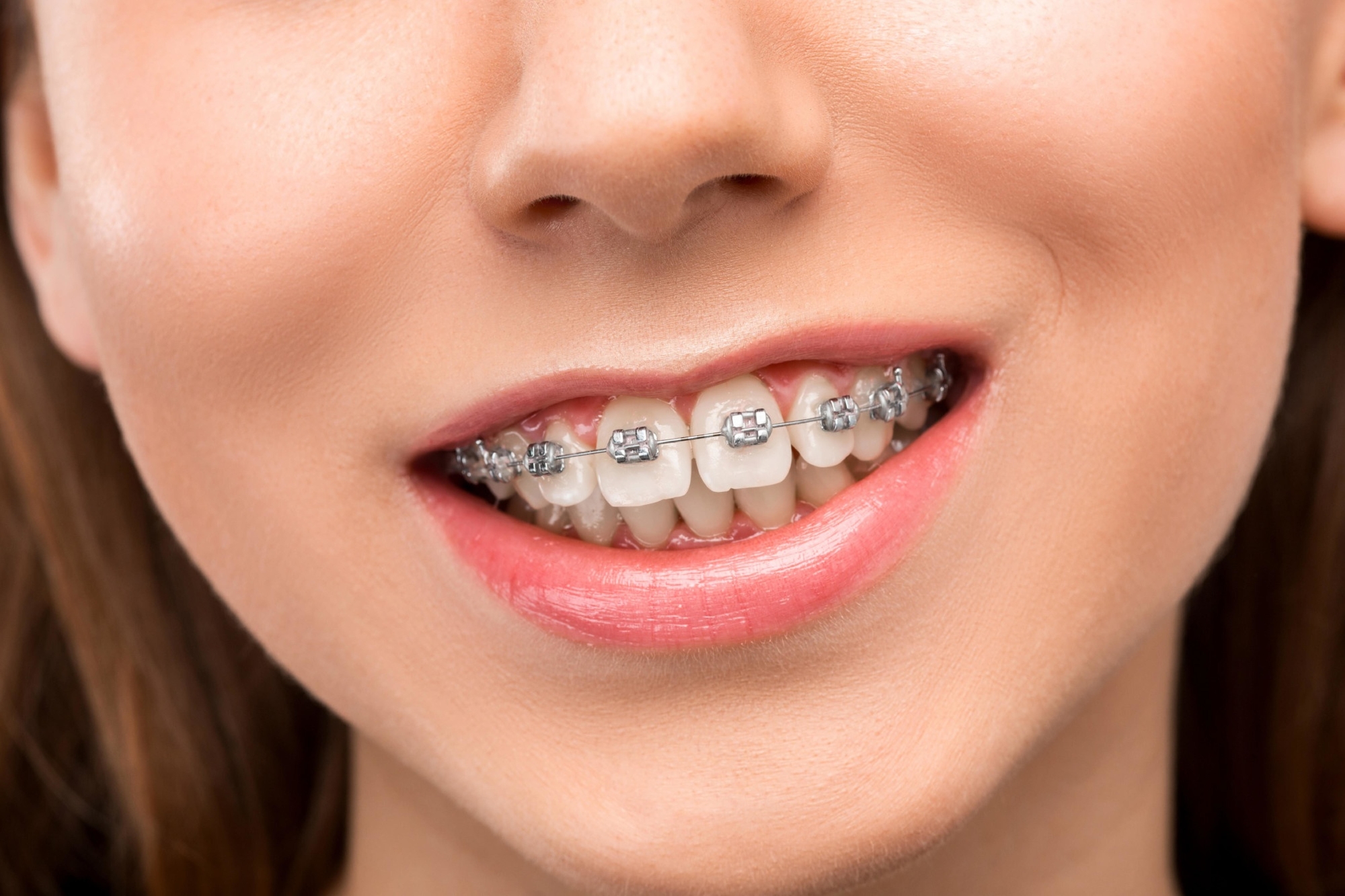 How To Take Good Care Of Your Braces? - Dentist Olds Alberta