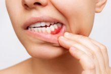 periodontal disease treatment in Olds