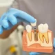 dental implants aftercare in Olds