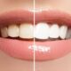 Teeth Whitening in Olds