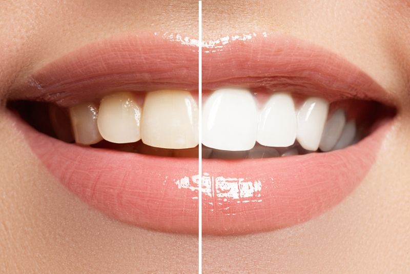 Teeth Whitening in Olds