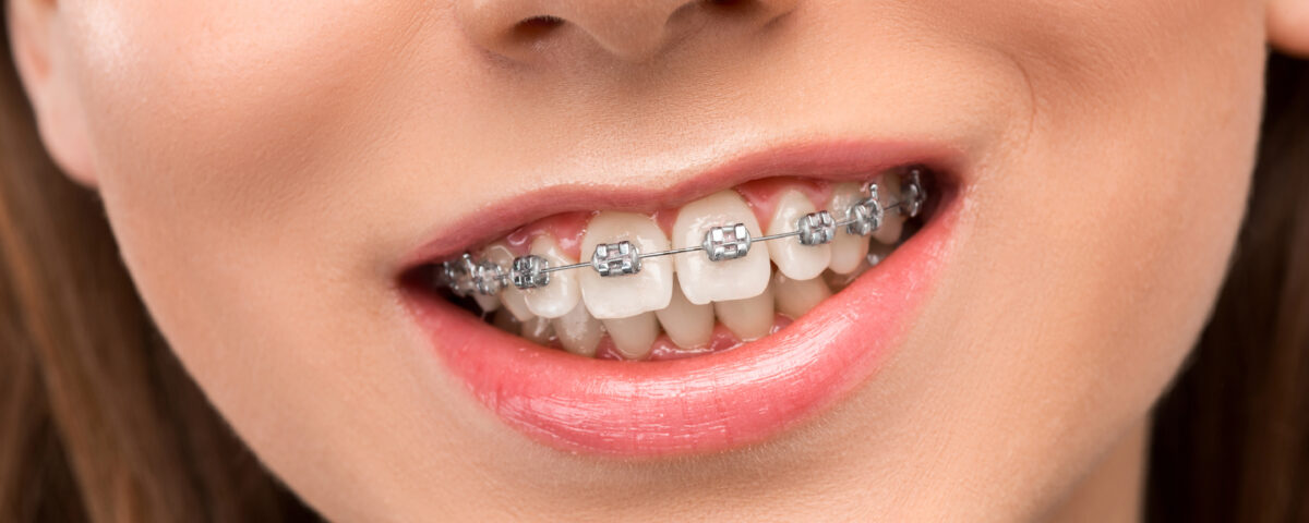 Dental Braces in Olds - West Olds Dental