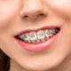 Dental Braces in Olds - West Olds Dental