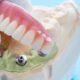 debunk common myths about dental implants in west olds dental