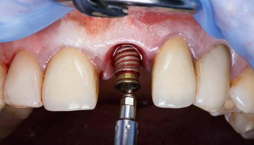 west olds dental dental implant dentist guide for successful dental implants