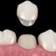 west olds dental cosmetic dentist ceramic crowns 5 misconceptions debunked