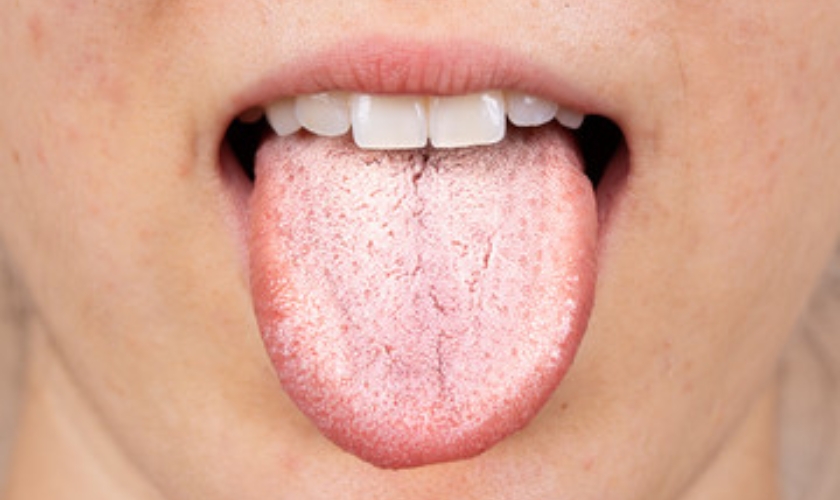 west olds dental white tongue and bad breath treatment