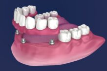 all on 4 dental implant surgery