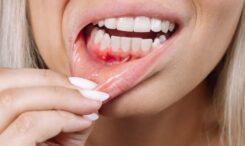 can stress cause gum disease