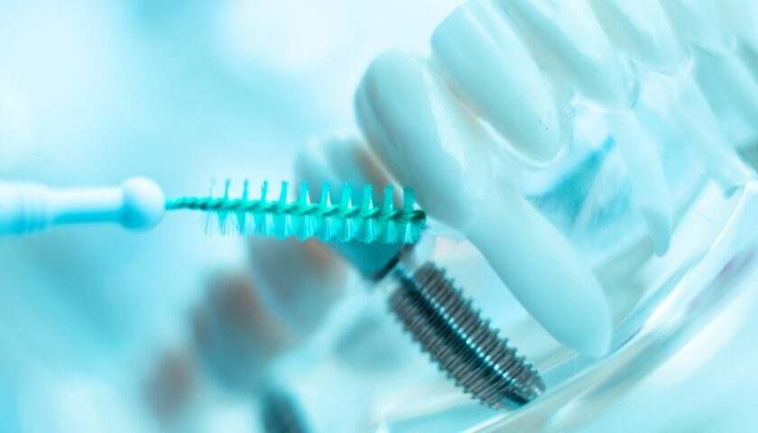 dental implants cleaning