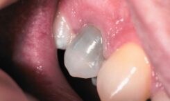 causes of tooth discoloration or black tooth