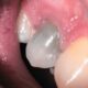 causes of tooth discoloration or black tooth