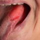 vitamin deficiency causes black spots on the tongue