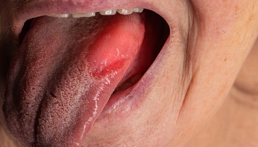 vitamin deficiency causes black spots on the tongue