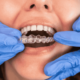 how invisalign correct common orthodontic issues