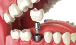what to expect during your dental implant recovery