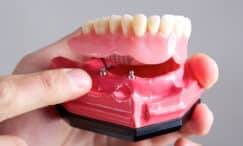 why you should consider Implant-supported dentures