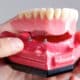 why you should consider Implant-supported dentures