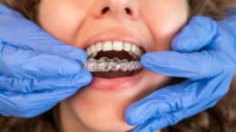 can-invisalign-fix-overbite